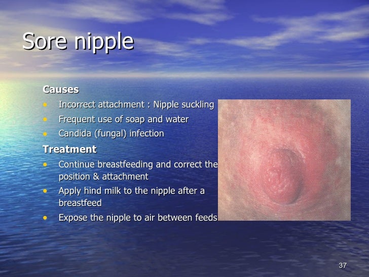 breast feeding yeast infection Breast feeding yeast infection